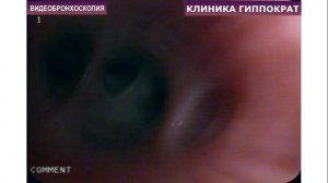 Как проводится бронхоскопия