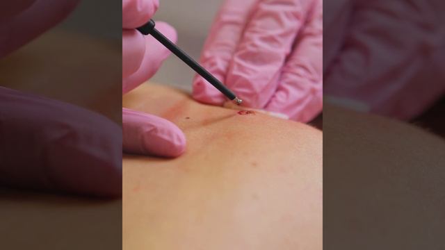 Удаление новообразований различными электродами.
