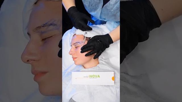 Реструктуризация периорбитального участка реструктуризантом RENOVA REVITAL