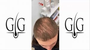 Пересадка волос в Москве.           Вопрос о густоте пересаженных волос.