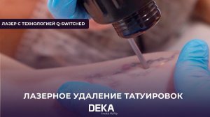 Лазерное удаление татуировки I Лазер с технологией Q-SWITCHED