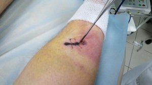 "Тонзилор ММ" в лечении гнойной раны