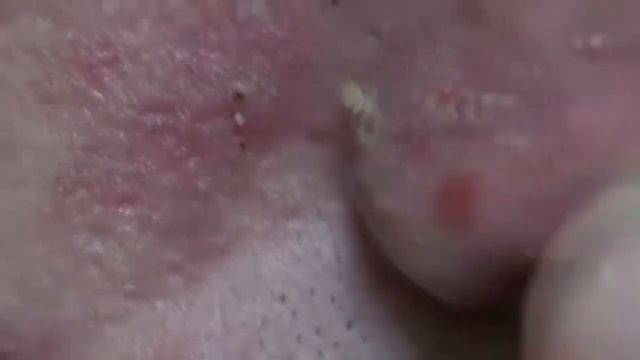 Огомный прыщ. Выдавливание прыщей. смотреть онлайн