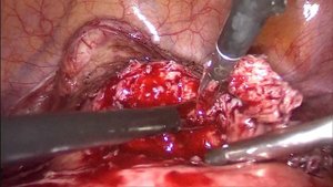 Isthmocele repair. Метропластика
