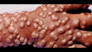 Тест на трипофобию (болезнь, которая может быть у каждого человека)