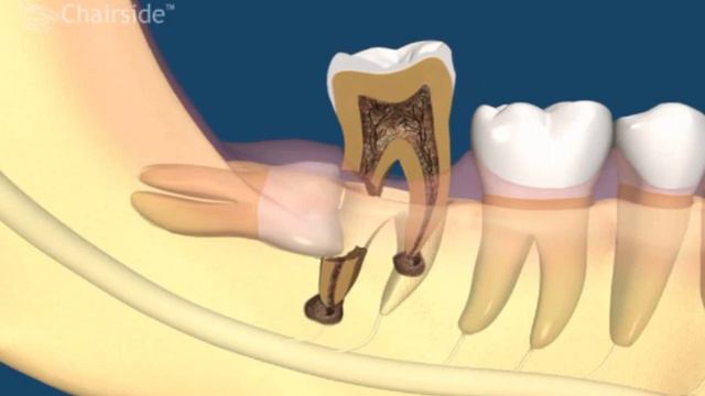 Как зарастает зуб мудрости фото разрушение 7 зуба зубом мудрости - смотреть видео онлайн от "Дискуссия и дискусс