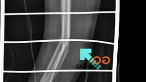 #перелом средней трети обеих костей #предплечья со смещением. #Рентген анатомия.