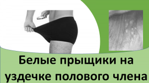 Белые прыщики на уздечке полового члена