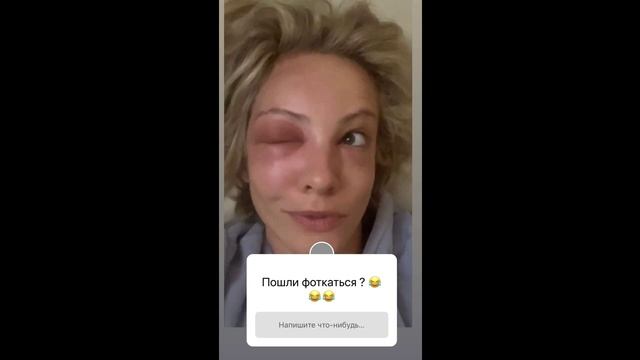 «Буду говорить, что вколола ботокс»: Полина Максимова пострадала от укуса пчелы