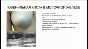 Ювенильная киста молочной железы