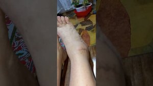 пюПерелом таранной кости. Прошёл 1год!