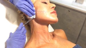 biostimolazione skin colin