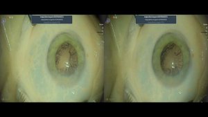 B+L Luxsmart Toric Lukan Mishev live stream