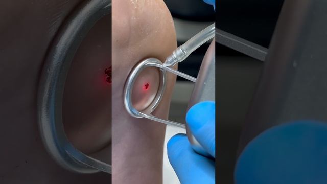 Лазерне видалення бородавки СО2 лазером смотреть онлайн