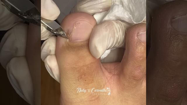 Essa ficou sem a lateral da unha #unhaencravada #satisfying #ingrown_toenail #nails смотреть онлайн
