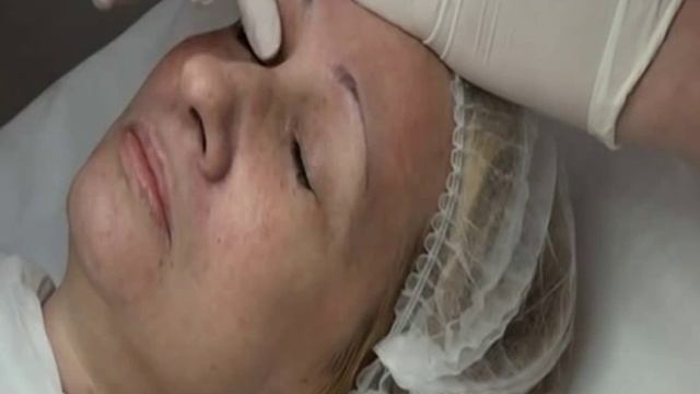 Пилинг - пятна на коже и гиперпигментация смотреть онлайн