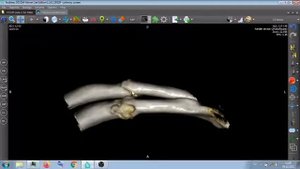 КТ ПЕРЕЛОМ РЁБЕР .