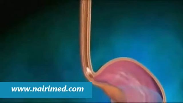 Капсульная эндоскопия в МЦ Наири смотреть онлайн