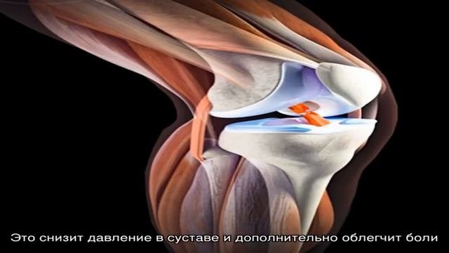 Препателлярный бурсит