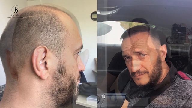 hair transplant before and after / результат пересадки волос смотреть онлайн