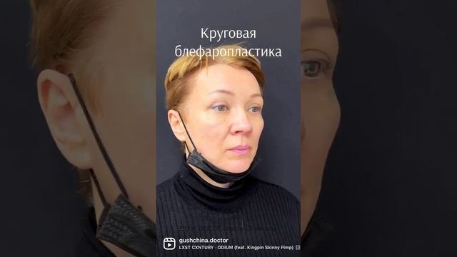 Круговая блефаропластика / пластическая хирургия