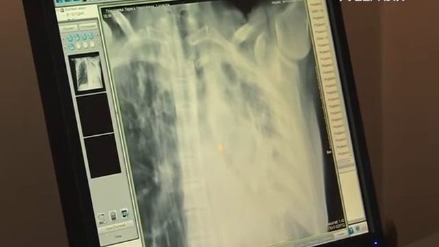 В Самарской области сократилась заболеваемость туберкулезом смотреть онлайн