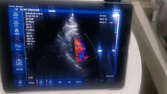 Беспроводной сканер УЗИ смотреть онлайн