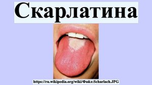 Скарлатина