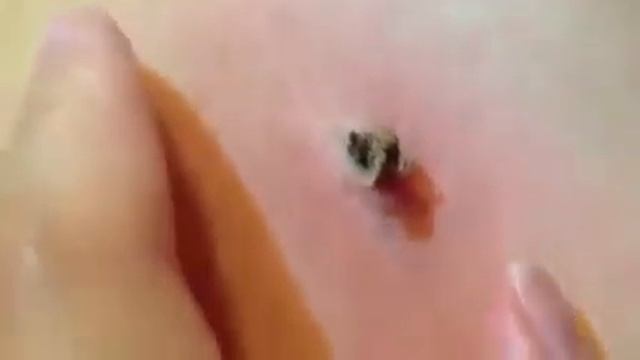 ЗАСОХШАЯ 20 ЛЕТНЯЯ ЧЕРНАЯ ТОЧКА смотреть онлайн