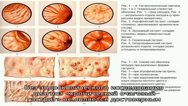 Симптомы и лечение очагового гастрита смотреть онлайн