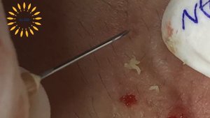 Clean Giant Blackheads on on the Lips