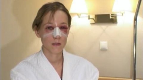 Ринопластика (пластика носа) и септопластика