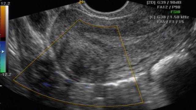 MIOMA INTRAMURAL QUE COMPROMETE ENDOMETRIO смотреть онлайн