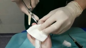 Удаление вросшего ногтя! Разрез Пальца!