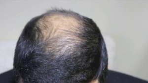 До и после пересадки волос в Турции 3100 графтов | Отзыв на пересадку волос в Турции Fue методом