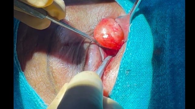 Dermoid cyst Excision: from Inferior orbit under Local Anesthesia (SURGERY VIDEO) смотреть онлайн