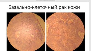 Базально клеточный рак кожи