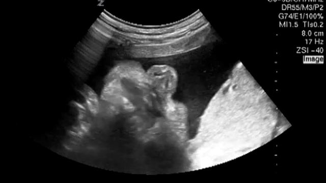 Малыш жует в животике мамы. Беременность 31-32 недели.