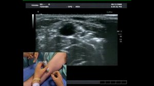 Боль в руке Блокада под УЗИ контролем Срединный нерв Median Nerve Block Ultrasound guided
