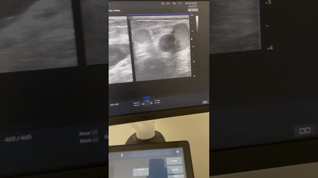 Рецидив после лазерной операции варикоза. ЭВЛК. Как лечить варикоз? Лечение вен. Флеболог Москва смотреть онлайн