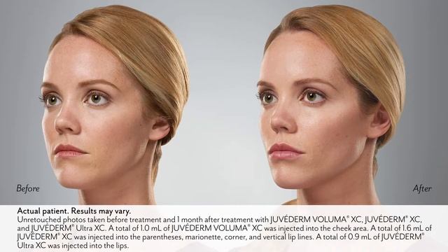 Juvederm Dermal Fillers & Wrinkle Treatment l Mill Creak Skin & Laser смотреть онлайн