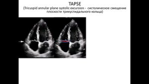 ОСНОВЫ ЭХОКАРДИОГРАФИИ: Оценка структуры и функции правого  желудочка