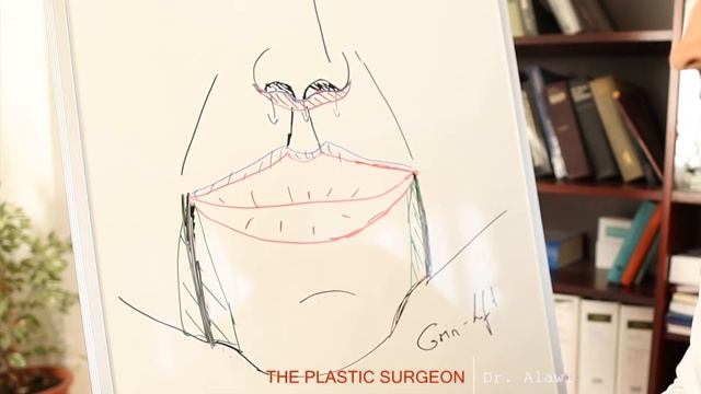 Angela Merkel: Merkelfalte Mundwinkel-Lifting | Grin lift | Botox | Hyluronsäure | Dr. Alawi