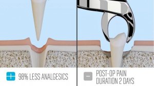 Piezotome CUBE vs Rotary Burr