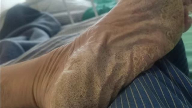 В госпитале по ранению, и боевые мозоли.