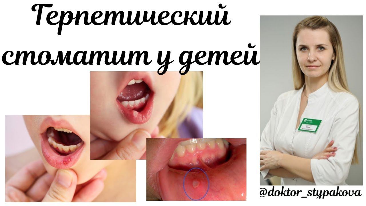 Герпетический стоматит у детей.Диагностика.Лечение.