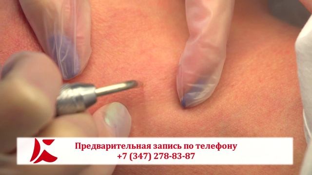 Удаление папиллом смотреть онлайн