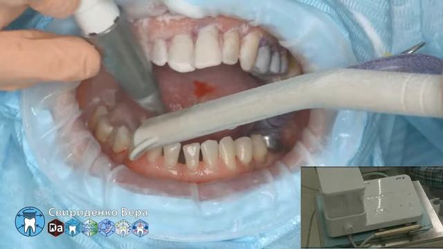 Professional oral hygiene -case 014 Acteon DTE Dentsply Coxo Floweis 3M KerrHawe (FHD multistream)