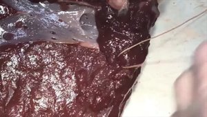 Гемостастические швы печени. Шов Джордана и Роббинсона-Батчера
