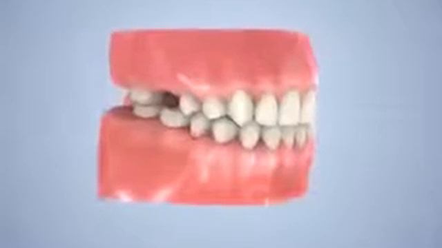 Бюгельный протез на кламерах в Харькове смотреть онлайн